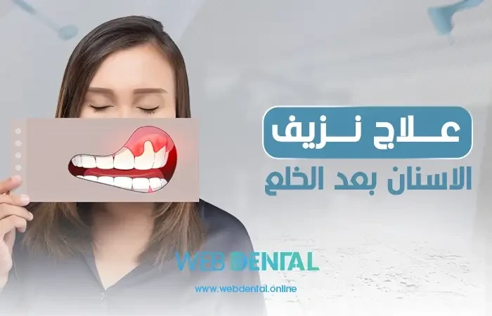 علاج نزيف الاسنان بعد الخلع image