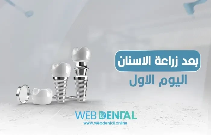 بعد زراعة الاسنان اليوم الاول image