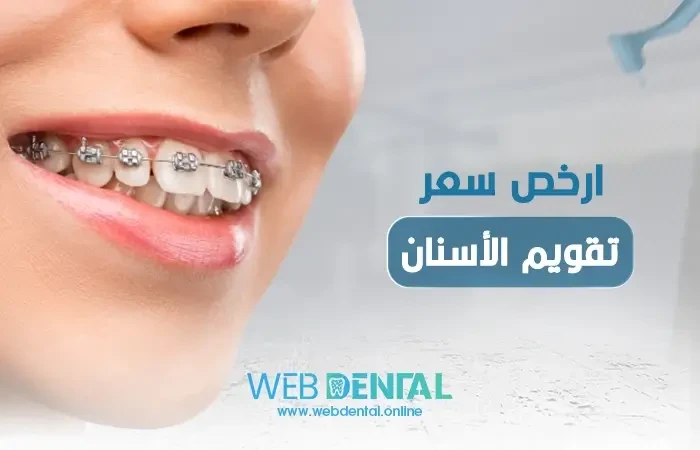 ارخص سعر تقويم الأسنان image