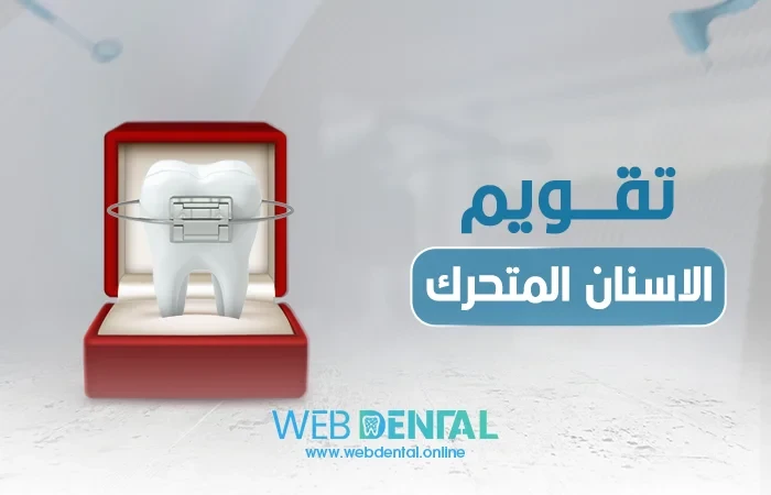 تقويم الاسنان المتحرك image