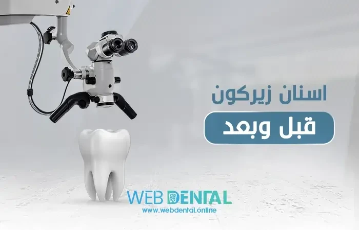 اسنان زيركون قبل وبعد image