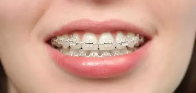 مدة تقويم الأسنان image