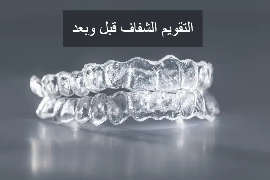 التقويم الشفاف قبل وبعد image