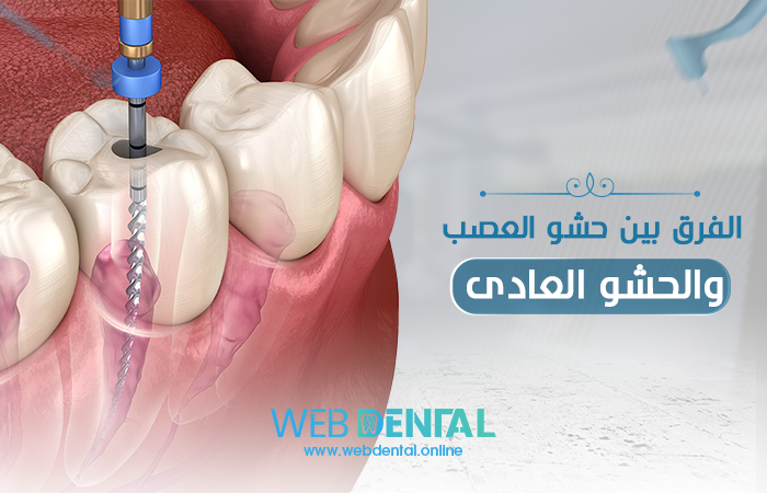 الفرق بين حشو العصب والحشو العادى image
