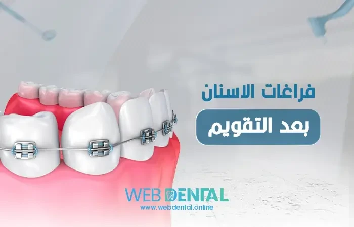 فراغات الاسنان بعد التقويم - مثبت الأسنان هو الحل image
