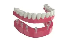 تكلفة زراعة عظم الفك في مصر image