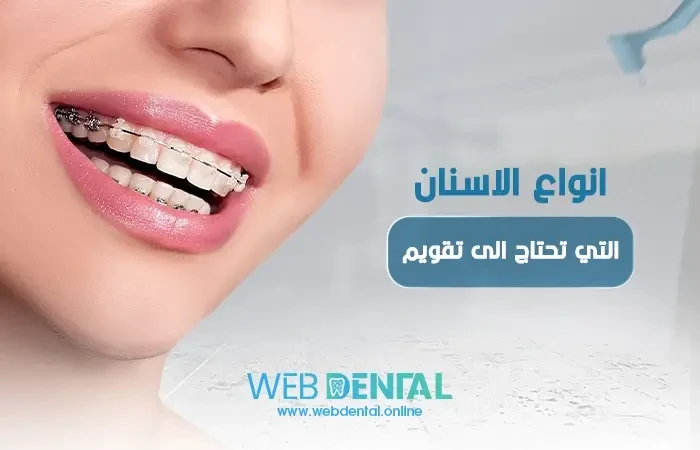 انواع الاسنان التي تحتاج الى تقويم image