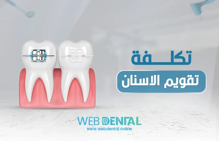تكلفة تقويم الاسنان image