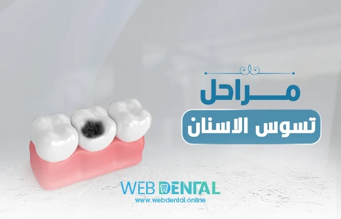 مراحل تسوس الاسنان image